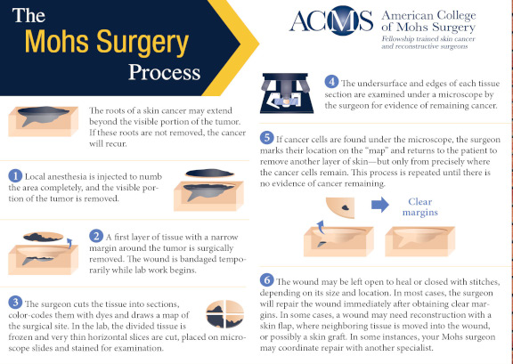 Mohs Surgery